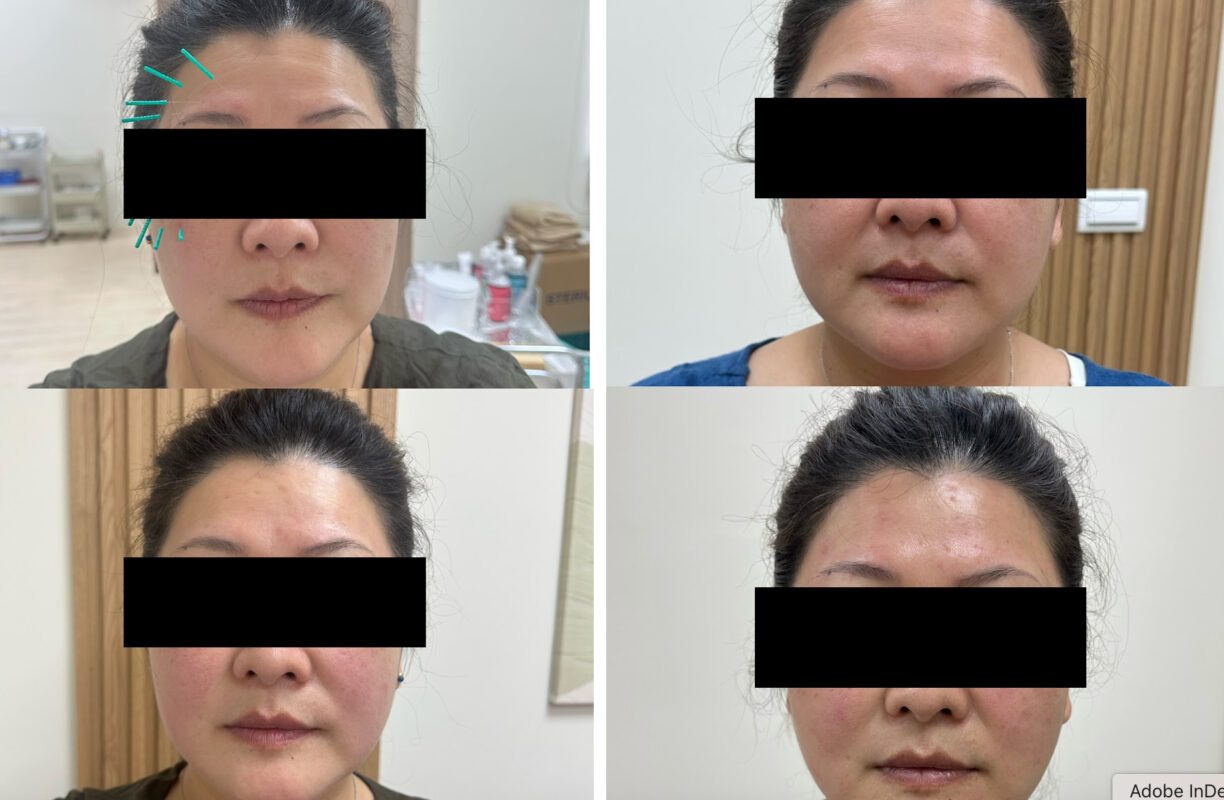 中醫 美顏針 案例1