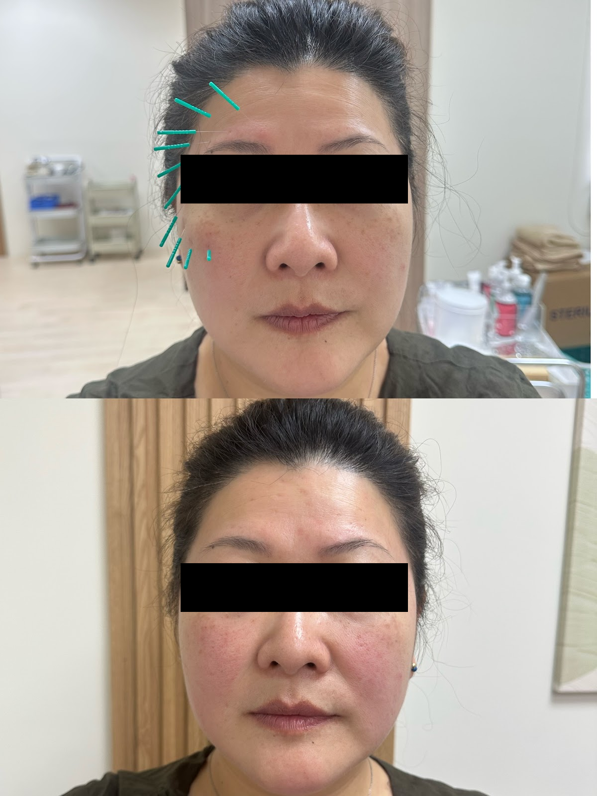 中醫 美顏針 案例2