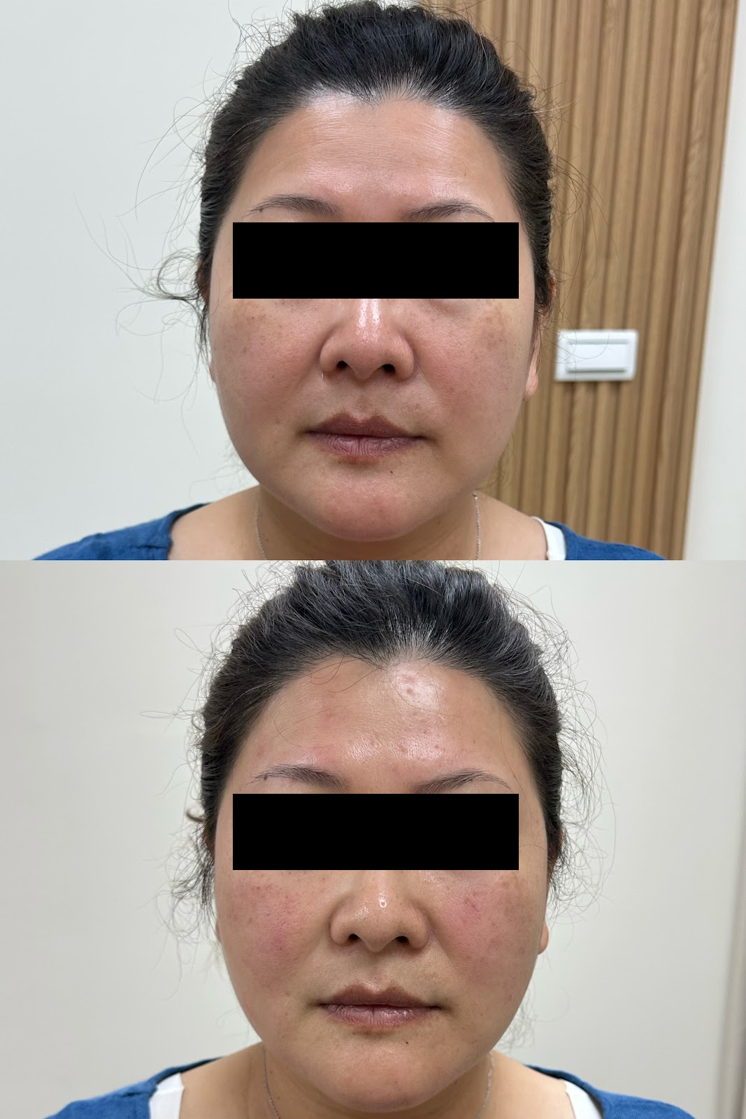 中醫 美顏針 案例3