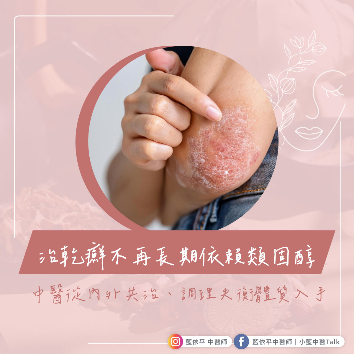 治乾癬不再長期依賴類固醇 藍依平中醫師｜依心為你-小藍中醫師