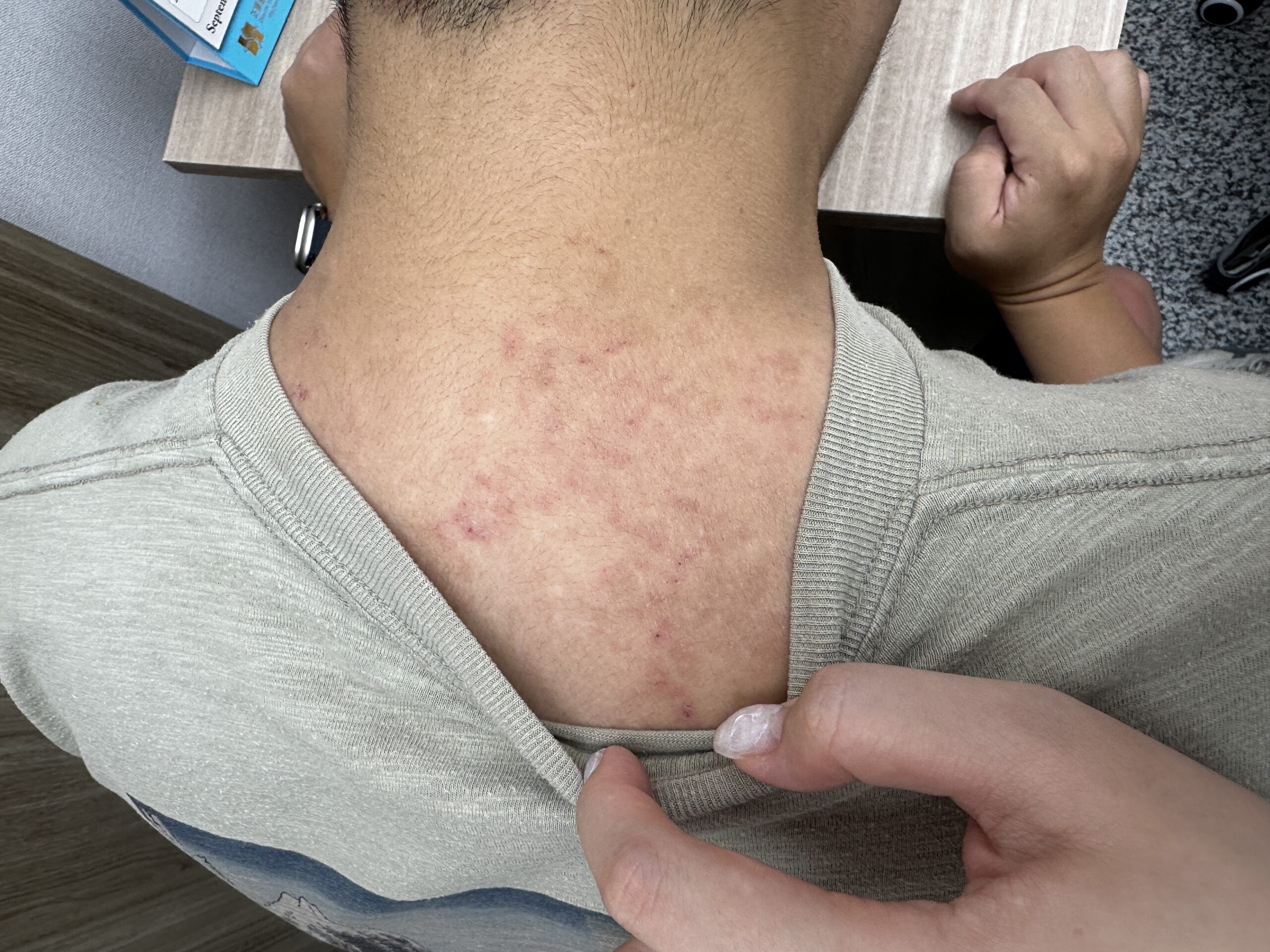 38歲奶爸的皮膚炎：其實是體內濕熱在作怪 藍依平中醫師｜依心為你-小藍中醫師