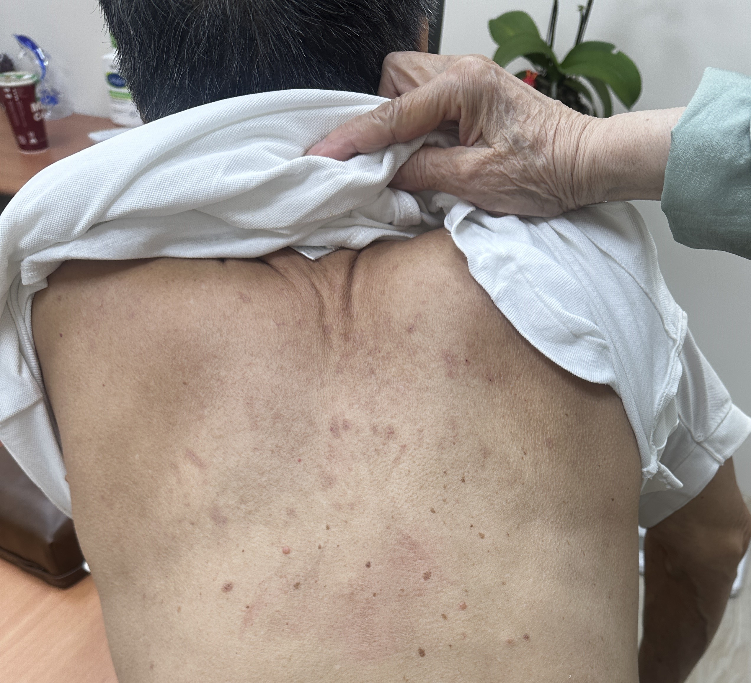 83 歲伯伯的蕁麻疹:1週中藥治療止癢退疹 83 歲伯伯的蕁麻疹:1週中藥治療止癢退疹 藍依平中醫師|依心為你-小藍中醫師