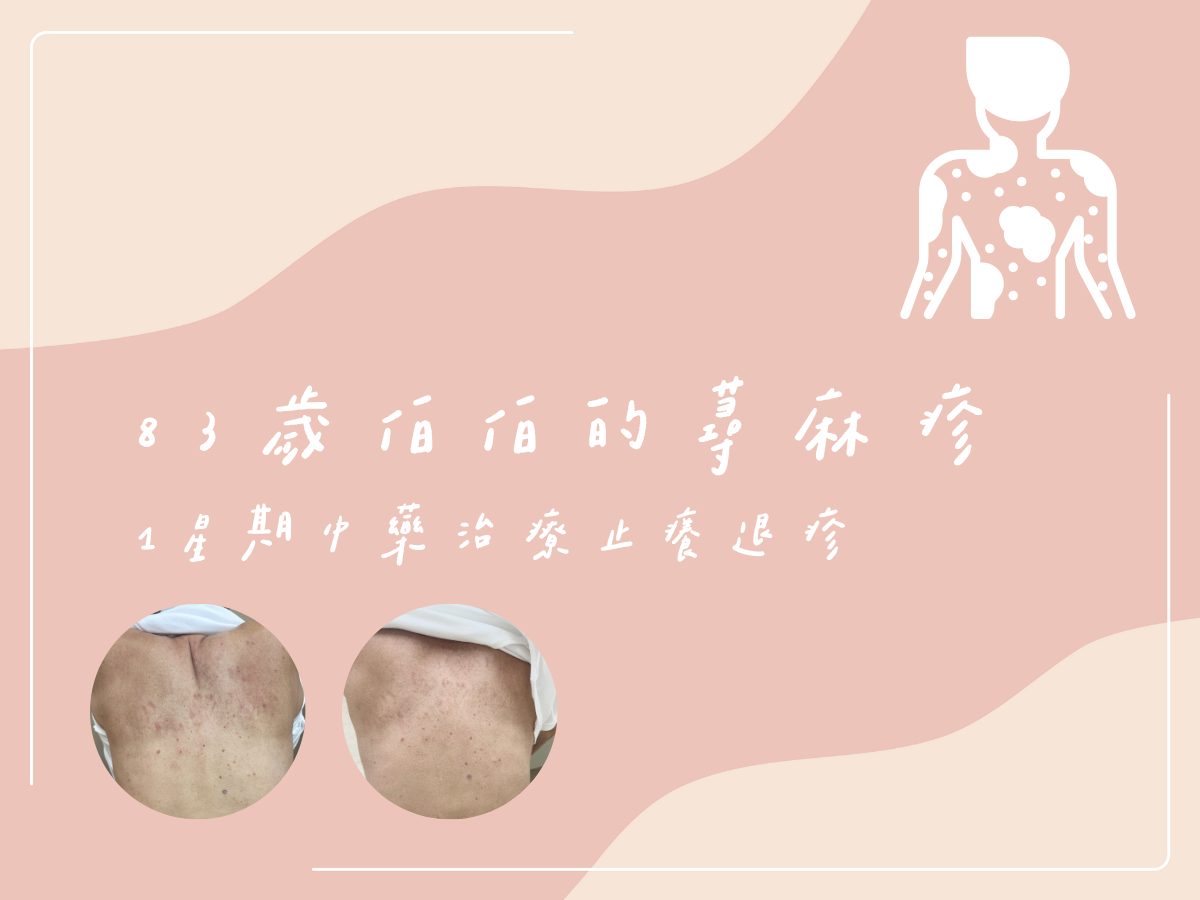 83 歲伯伯的蕁麻疹：1週中藥治療止癢退疹 藍依平中醫師｜依心為你-小藍中醫師