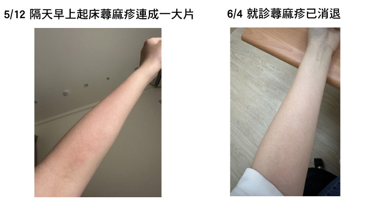 換季皮膚癢、濕疹蕁麻疹怎麼辦?中醫教你從根本體質調理! 蕁麻疹 案例